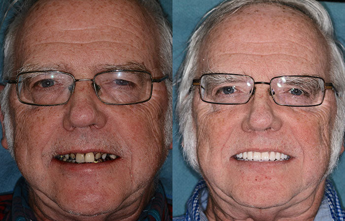 Hermsa® --🦷Advanced Customized Full Denture Set🦷