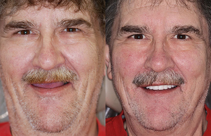 Hermsa® --🦷Advanced Customized Full Denture Set🦷