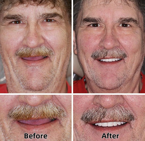 Hermsa®-Advanced Custom-Fit Functional Dentures