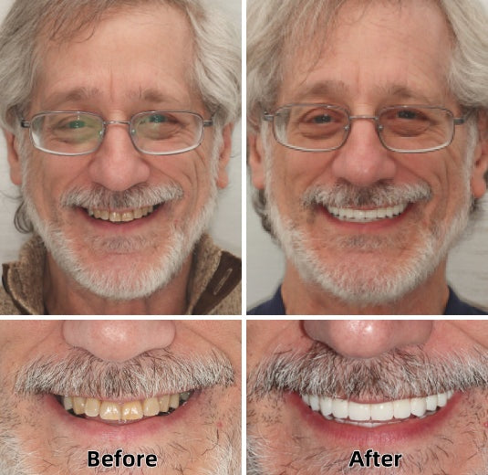 Hermsa®-Advanced Custom-Fit Functional Dentures
