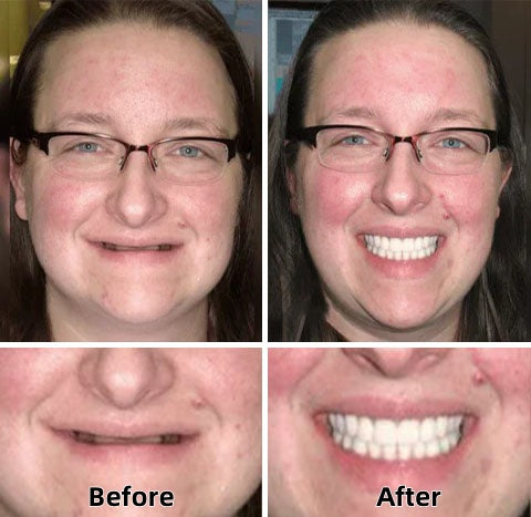 Hermsa®-Advanced Custom-Fit Functional Dentures