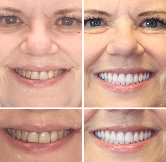 Hermsa® --🦷Advanced Customized Full Denture Set🦷