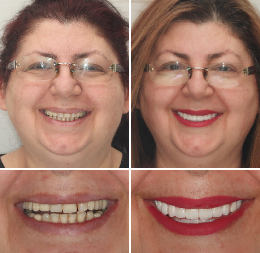 Hermsa® --🦷Advanced Customized Full Denture Set🦷