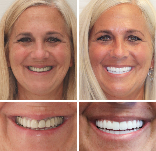 Hermsa® --🦷Advanced Customized Full Denture Set🦷