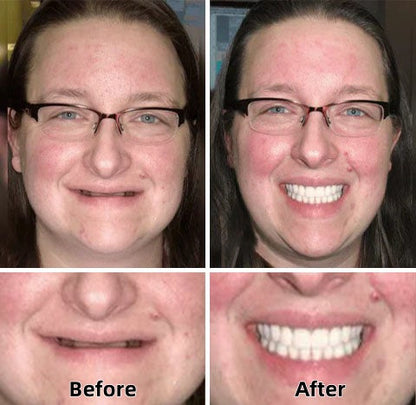Hermsa®-Advanced Custom-Fit Functional Dentures