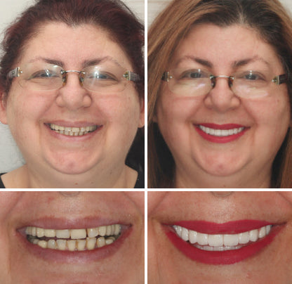 Hermsa® --🦷Advanced Customized Full Denture Set🦷