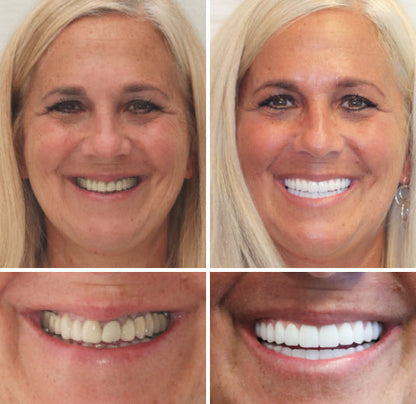 Hermsa® --🦷Advanced Customized Full Denture Set🦷